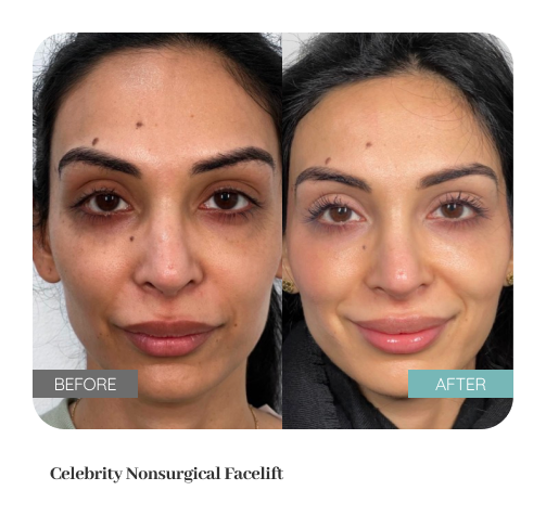 Before and after treatment result — Dr. Lanna, LC Medical Aesthetics NYC